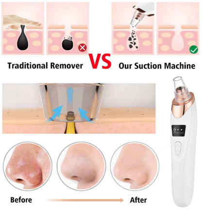 Limpiador puntos Negros